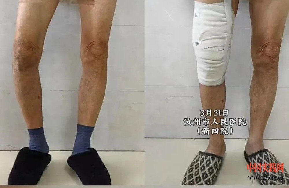 汝医现场：汝州真牛！3D打印技术重塑“不老盖”